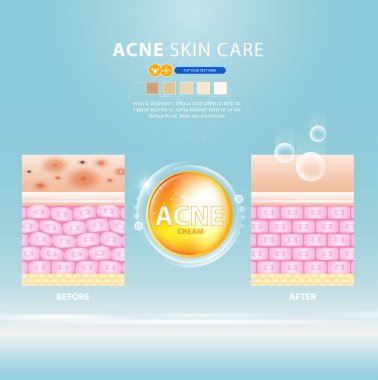 sivilce lekesi sorunlu vektör tasarımı.