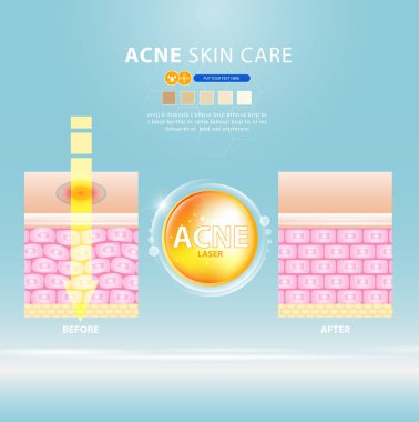 sivilce lekesi sorunlu vektör tasarımı.