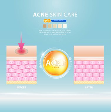 sivilce lekesi sorunlu vektör tasarımı.