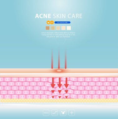 sivilce lekesi sorunlu vektör tasarımı.