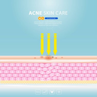 sivilce lekesi sorunlu vektör tasarımı.