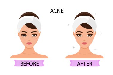 Kızın yüzünde sivilce var. Öncesi ve sonrası. Cilt bakımı kavramı, saf ve sağlıklı cilt. Vektör çizimi.