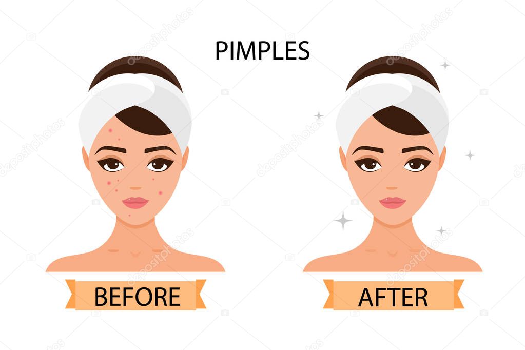 Girl has pimples on her face. Before and after. Concept of skincare, pure and healthy skin. Vector illustration