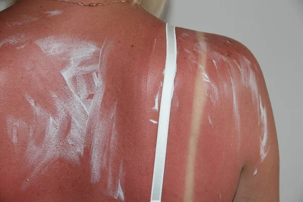 Sunburn Beach Sun Light Shoulder Back Caucacian Girl Woman Sunburn — Stock Photo, Image