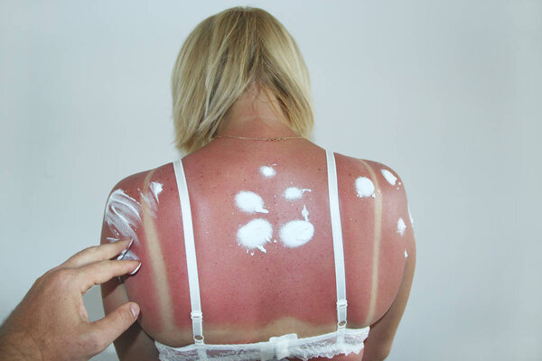 Woman with back burned from sunburn at doctor's reception. Human body burnt after sunburn. Scald of back made by sunny beams. Human skin after excessive sunbathing