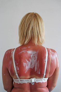 Plaj sonra kadın vücudunda sütyen izi. Vücut bakımı. Kadın sunburning sonra geri tedavi krem üzerinde. Genç kadın, egzotik tatil sonra ile koruyucu krem sürülür. Cilt Bakımı