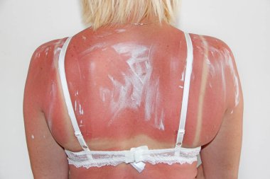 Genç kadın, egzotik tatil sonra ile koruyucu krem sürülür. Plaj sonra kadın vücudunda sütyen izi. Vücut bakımı. Kadın sunburning sonra geri tedavi krem üzerinde. Cilt Bakımı