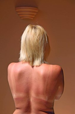 İnsan geri sonra güneşte yanmış. Üzerinde geri güneş ışınları haslanma. Plaj ziyaret ettikten sonra kadın arka yüzündeki yanıklar. Kadın arkasında iz üzerinde sutyen tan sonra