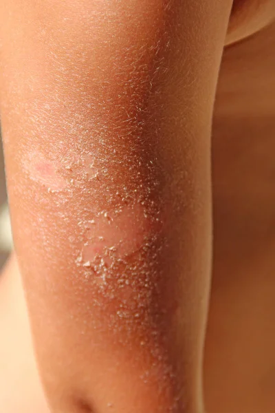 Burn on hand after sunburn. Traces of sunburn on arm — Stock Photo, Image