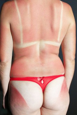 Beyaz kızın omuzlarında ve kalçalarında güneş ışığından güneş yanığı. Kadın güneş yanığı. Vücut bakımı