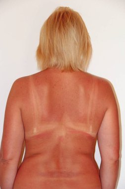 Güneş yanığından sonra sırtım yandı. Bir kadın cesedi. Plajı ziyaret ettikten sonra kadın sırtında yanıyor.