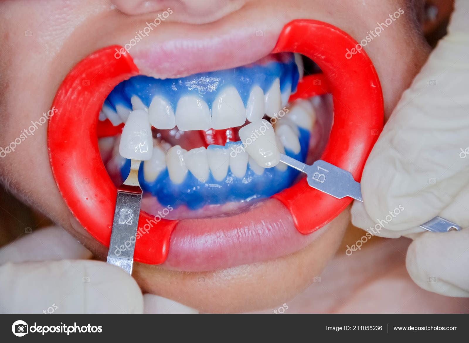 Denture Tooth Color Chart