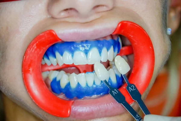 Fogorvos összehasonlítása a betegek fogai árnyalattal minták fehérítés kezelést. egészséges fogak fogfehérítés. Fogászati ellátás fogalma. Egy nő beteg a rendelő kellemes környezetben gyógyító fogorvos — Stock Fotó