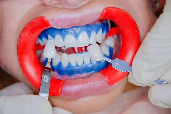 Tandarts afwerking van tanden whitening procedure met jonge vrouw. Zie een resultaat. Tandarts houden tanden van kleur chart.dentist office tanden zorg en gezondheid concept-tands — Stockfoto