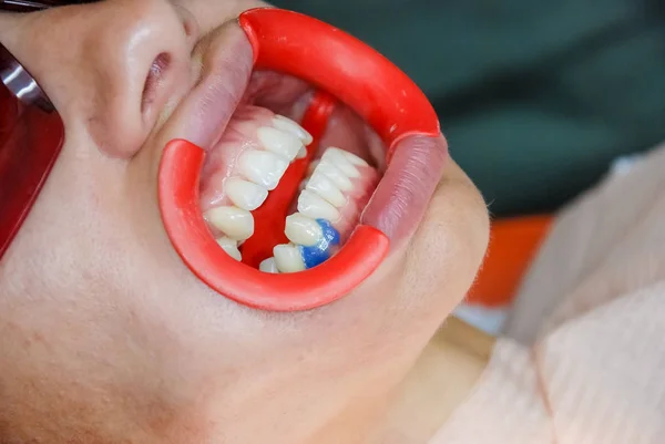 Portrait en gros plan d'une patiente en visite chez le dentiste pour le blanchiment des dents en clinique, procédure de blanchiment des dents.Vérifiez et sélectionnez la couleur des dents. Dentiste rend le processus de traitement en dentaire — Photo