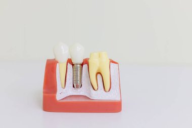 Dental implant modeli. İnsan implant diş. Diş kavramı. İnsan diş ya da protez. Implan modeli diş destek fix köprü implan ve taç. Genel Diş Implant çalışma çözümleme Crown Köprüsü