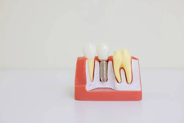 Dentsts dental protetiska tänder, tandkött, rötter undervisning student modell med titan metall skruv implant.tooth modell, skalfasader, implantat. Kopiera utrymme — Stockfoto