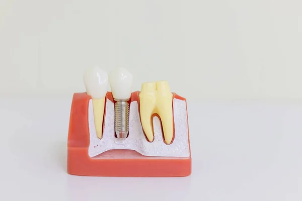 Modelo de implante dentário. Implante humano dentário. Conceito dentário. Dentes humanos ou dentaduras. Implan model tooth support fix bridge implan and crown.Genéricos Dental Implant Study Analysis Crown Bridge — Fotografia de Stock