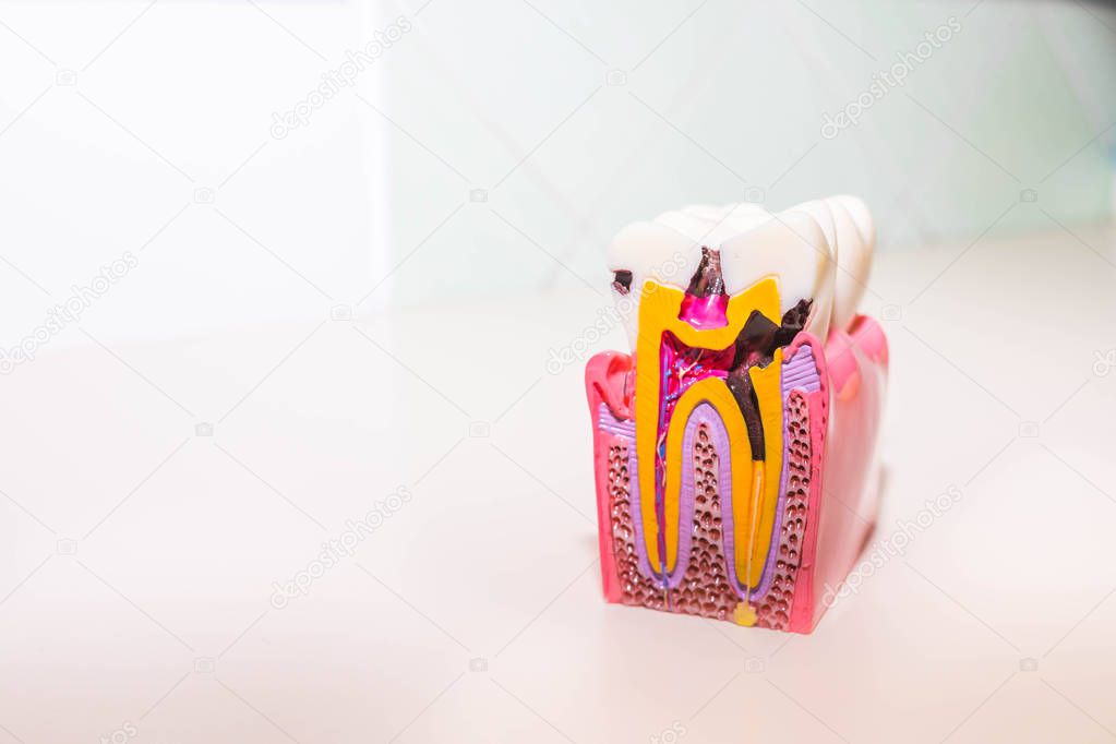 tooth model with caries, tooth decay in dentists office. Healthy teeth concept . Big tooth model with details on the nerve, dentin, enamel, cavities and abscesses, dental diseases.Copy space