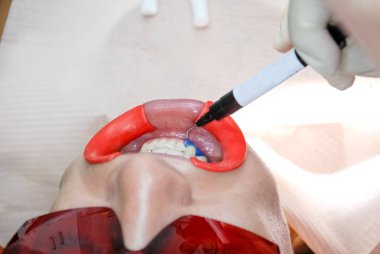 bir ultraviyole lamba yardımı ile beyazlatma için ağız boşluğu bir hazırlık vardır. Close-up.girl özel koruyucu jel yardımı ile diş beyazlatma prosedürü uğrar