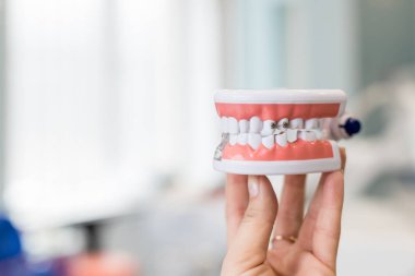 Tel parantez bağlı insan çene modeli. Diş ve ortodontik ofis sunum aracı, kadın elinde izole. Yapay çenelerde dişler üzerinde metal ve seramik diş telleri. Kopyalama alanı