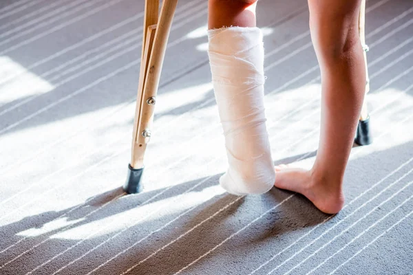 Ragazza con una gamba rotta. Primo piano dei piedi, uno con una benda in gesso. stecca piede per il trattamento di lesioni da ossa rotte. distorsione della caviglia dopo il salto sul trampolino — Foto Stock