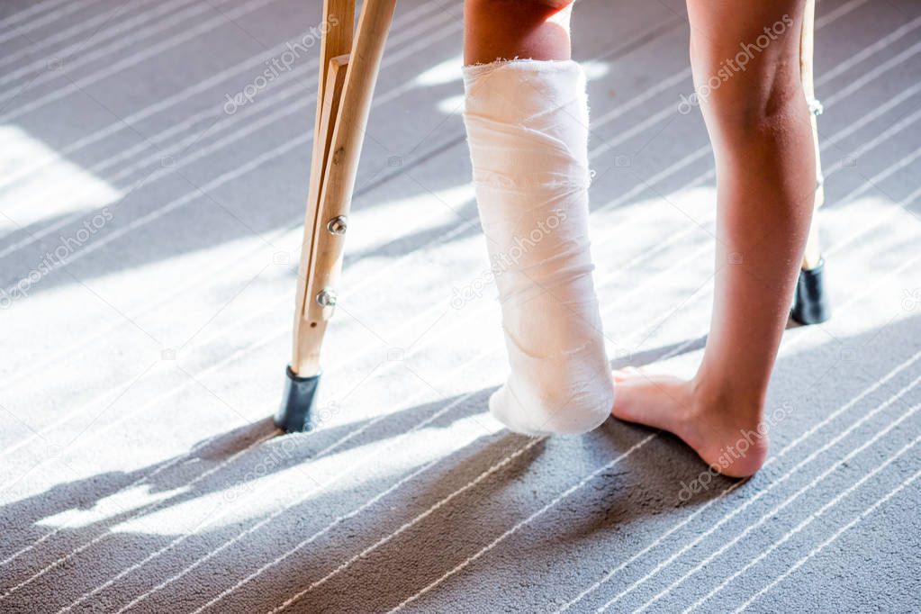 girl with a broken leg .close-up of feet, one with a plaster bandage. foot splint for treatment of injuries from broken bones. ankle sprain after jumping on the trampoline