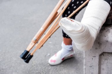 Tanınmayan bir kız, kırık bir bacak ve koltuk değnekleriyle sokakta oturuyor. Koltuk değnekleriyle engelli bir kız. Trambolinde atlarken kaza geçirmiş. Ayak bileği kırığı..