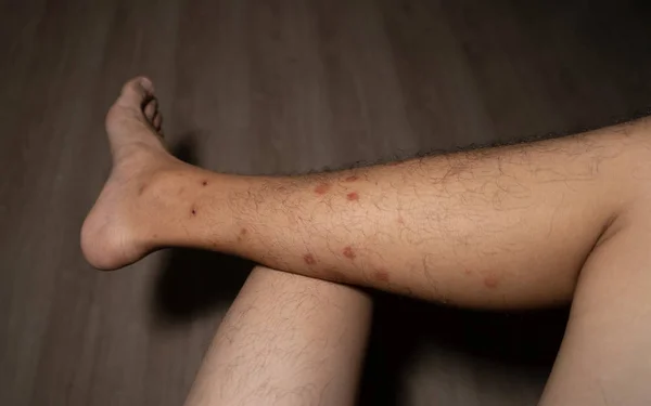 Primer plano de una pierna de hombre con alergia a insectos, mosquitos o insectos b —  Fotos de Stock