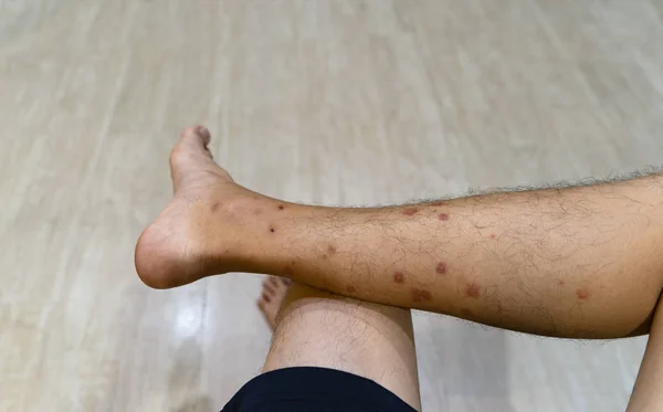 Primer plano de una pierna de hombre con alergia a insectos, mosquitos o insectos b —  Fotos de Stock