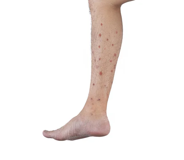 Böcek, sivrisinek veya böcek b alerjisi olan bir erkek bacağının yakın — Stok fotoğraf