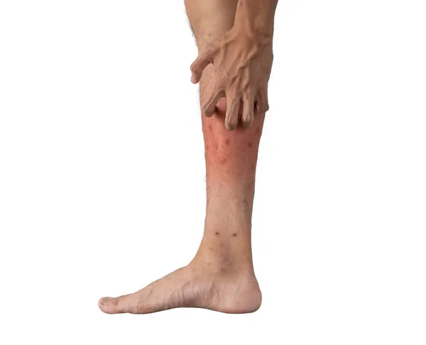 Primer plano de una pierna de hombre con alergia a insectos, mosquitos o insectos b — Foto de Stock