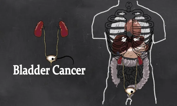 Bladder Cancer Anatomy Illustration with Urinary Tract System. Simple Drawing in Classic Style on Blackboard — Stock Image Bladder Cancer Anatomy Illustration Urinary Tract System Simple Drawing Classic Stock Image