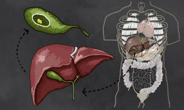 Ilustrasi Gallstone Dengan Torso Liver Dan Kandung Kemih Gall Untuk — Stok Foto