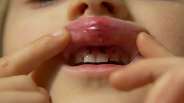A boca quebrada dos lábios — Vídeo de Stock