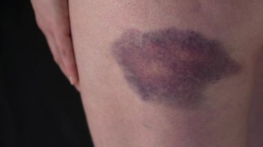 Kadın vücudu üzerinde morluk