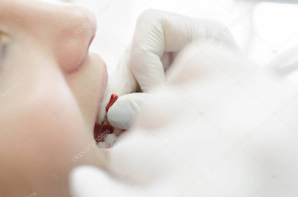 Close up of patient during teeth devitalization at dentist office.