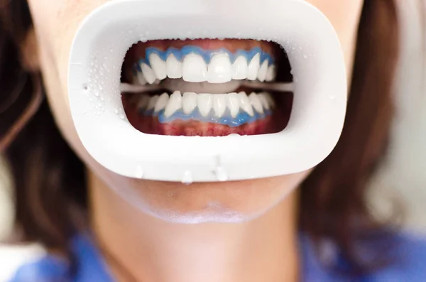 Close Paciente Sexo Feminino Com Dentes Brancos Como Resultado Clareamento — Fotografia de Stock
