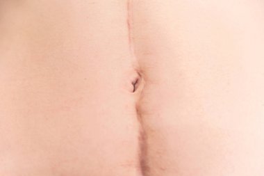 Close up of large surgical scar on female abdomen clipart