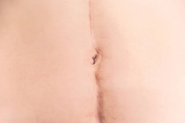 Primer Plano Gran Cicatriz Quirúrgica Abdomen Femenino —  Fotos de Stock