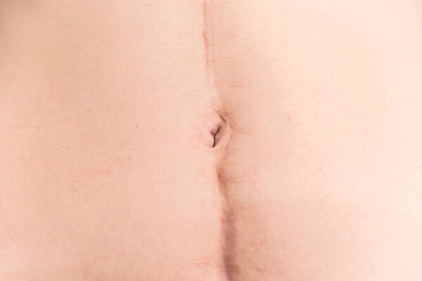 Close up of large surgical scar on female abdomen
