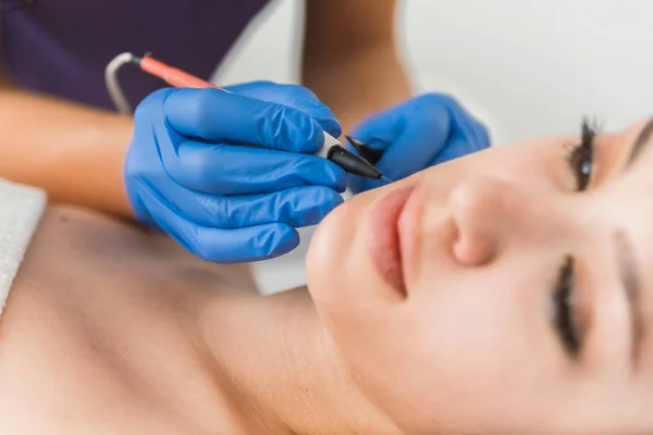 Dermatologista Fazendo Tratamento Remoção Cabelo Rosto Pacientes Com Eletrólise — Fotografia de Stock