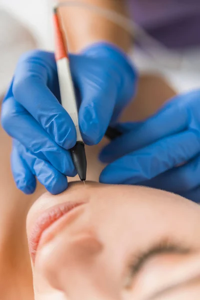 Close Doctors Hands Doing Electroepilation Patients Chin — Stock Photo, Image