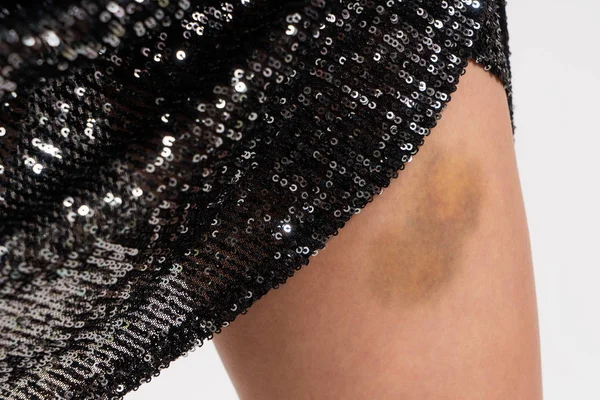 Closeup of a big bruise on a woman\'s leg covered by a black dress. Domestic abuse concept photo. White background.