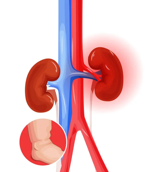 Inflammation Des Reins Organes Urinaires Humains Coeur Rein Vecteur Vessie — Image vectorielle