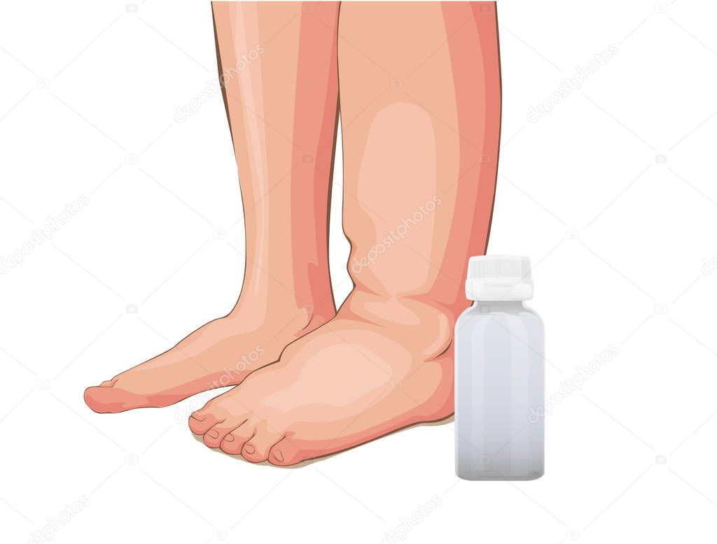 Swelling of the feet or kidney problems, medical vector illustration on a white background