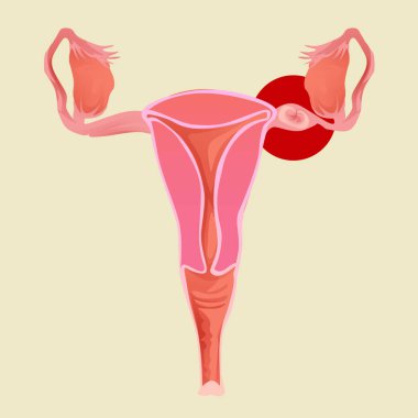 dış gebelik jinekolojisi ile rahim illüstrasyonu