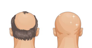 Beyaz arka plan üzerinde karikatür tarzı izole saç dökülmesi sorunu ile kız
