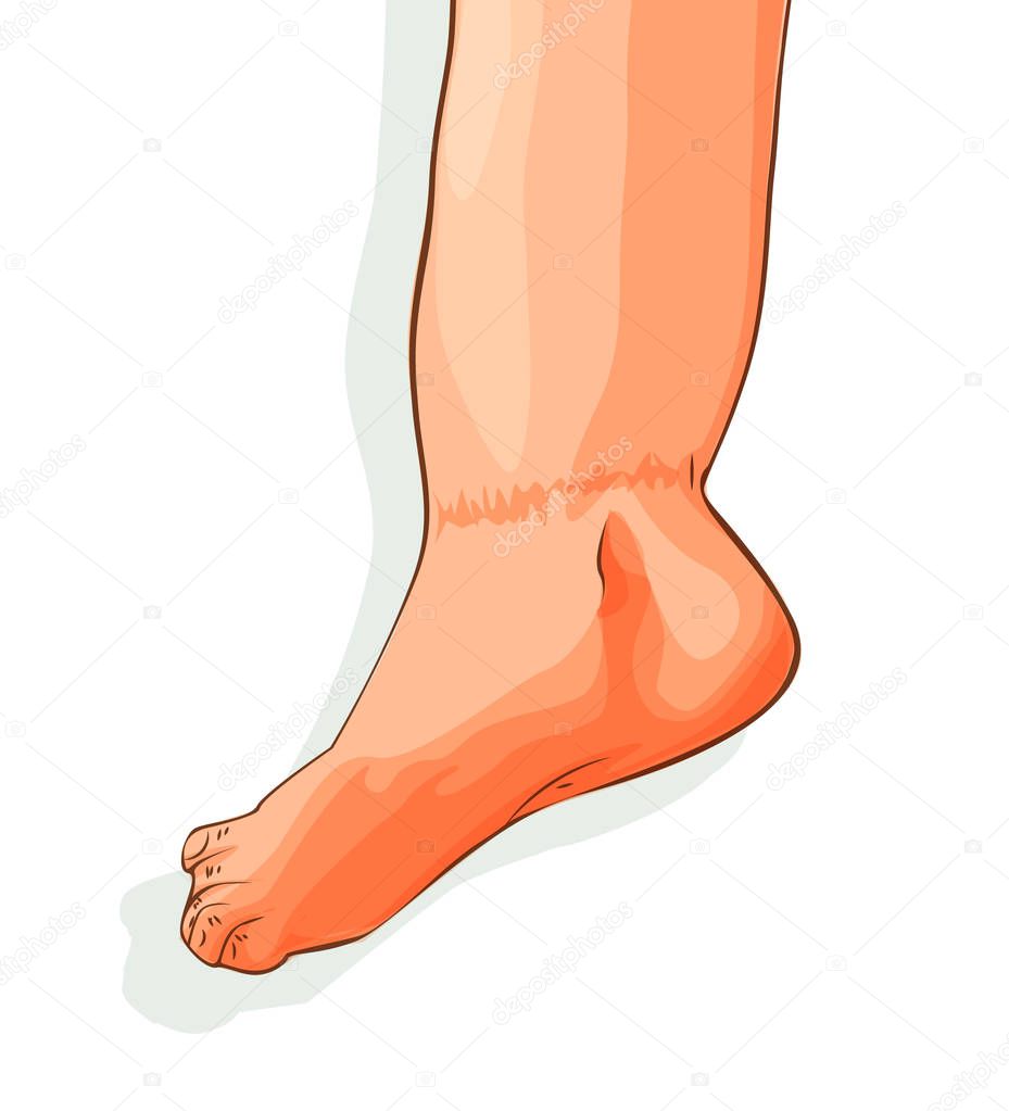 Vector illustration of edema on feet. Swelling of the feet and ankles.