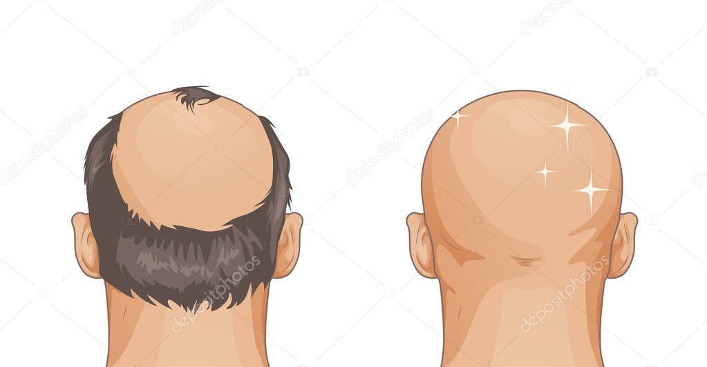 Girl with hair loss problem isolated on white background, cartoon style